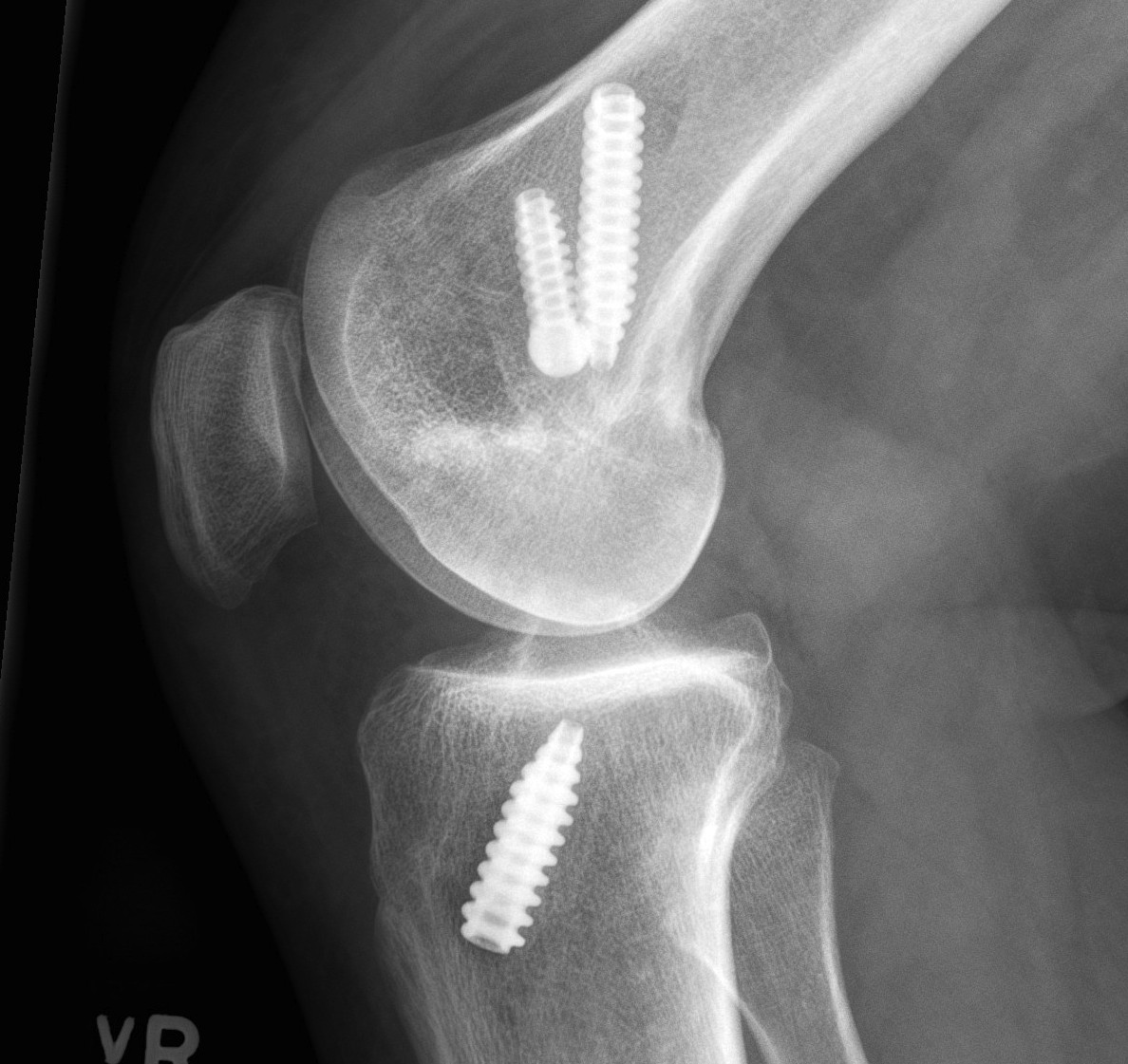 Revision ACL New Posterior Femoral Tunnel